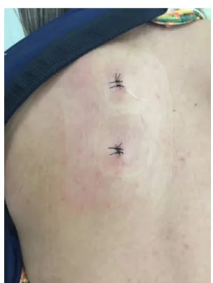 Fig. 5 – Esthetic aspect of the arthroscopic scapulothoracic surgery.