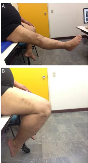 Fig. 4 – Four-year postoperative knee range of motion, showing full extension (A) and 120-degree flexion (B).