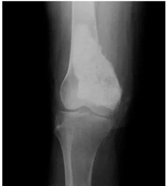 Fig. 1 – Post-surgery radiograph of the lesion indicating the presence of surgically-inserted orthopedic cement material.