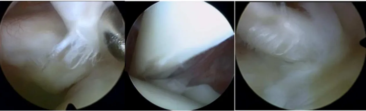 Figura 1 – Exemplos de lesão parcial da cabec¸a longa do bíceps vistos na artroscopia.