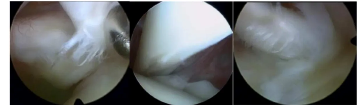 Fig. 1 – Examples of partial lesion of the long head of the biceps seen on arthroscopy.
