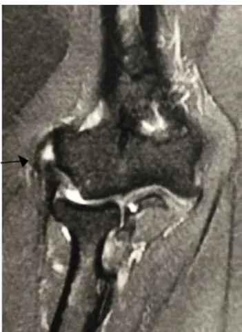 Fig. 1 – Magnetic resonance imaging showing common extensor tendon lesion (arrow).