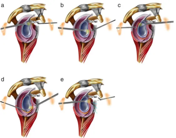 Fig. 1 – Surgical steps of the arthroscopic release for treating adhesive capsulitis. Sagittal section of the left shoulder showing (a) release of coracohumeral ligament (arrow), (b) anterior capsulotomy performed through the anterior portal, (c) posterosu