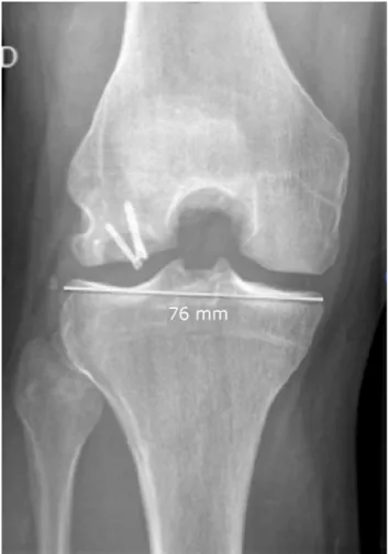 Fig. 2 – Measurement of the proximal tibia of the recipient for donor matching.