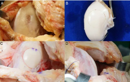 Fig. 3 – (A) Macroscopic appearance of osteochondritis dissecans lesion in the left medial femoral condyle; (B) Donor left medial femoral condyle with a cylinder prepared in the same anatomical site of the recipient’s defect; (C) FOA restoring the articula