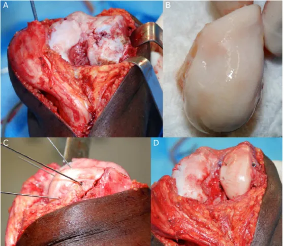 Fig. 4 – (A) Osteonecrosis sequelae in the lateral femoral condyle (LFC) with lateral parapatellar access route and medial patellar luxation; (B) LFC of the donor during surgery; (C) Aspect of the provisional fixation of the graft showing the congruence of