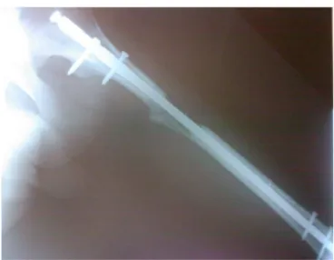 Fig. 1 – Radiographic image of a femur in the lengthening phase after osteotomy, undergoing lengthening.