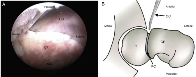 Figura 3 – A, imagem transoperatória de quadril esquerdo que evidencia o colo femoral (CF) e o osteótomo curvo (OC) durante osteotomia do colo no nível da fise de crescimento