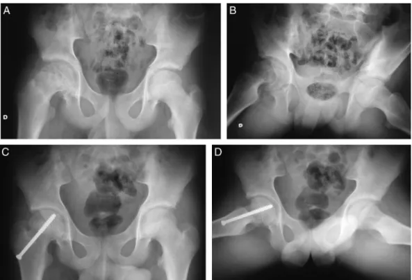 Figura 6 – Paciente masculino 11 anos. Dor no quadril direito havia dois meses, deambulava sem muletas