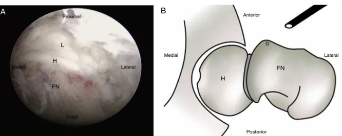 Fig. 1 – (A) Intraoperative image of hip arthroscopy for subcapital realignment in the treatment of chronic and stable SCFE, disclosing the exposure of the labrum (L), femoral head (H), and femoral neck (FN)