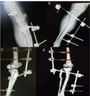 Figura 1 – a, radiografia simples em perfil; b, radiografia simples em anteroposterior; c, tomografia em perfil; d, tomografia em anteroposterior.