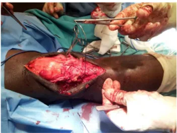 Fig. 1 – Lateral projection knee radiographs after bilateral patellar tendon rupture, showing cephalic patellar migration (“patella alta”), avulsion fractures of inferior poles of both patellae and an isolated undisplaced spiral fracture of the left fibula