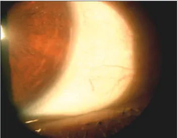 Figure 3 (case 1): Results of a specular microscopic examination showing severe guttata associated with corneal edema (on biomicroscopic exam), characterizing Fuchs Endothelial dystrophy.