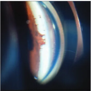 Figure 4 (case 2): Slit lamp evaluation showing temporal posterior embryotoxon in the right eye.