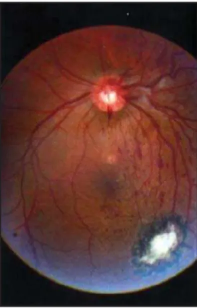 Figure 1: Retinography showing the recurrence of retinal vein occlusion in the left eye