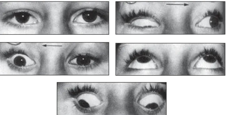 Figure 6: Bilateral Duane’s syndrome (severe type I in the right eye and type II in the left eye); There is orthotropia in primary position and supraversion and divergence in infraversion (abnormal abduction of the right eye)