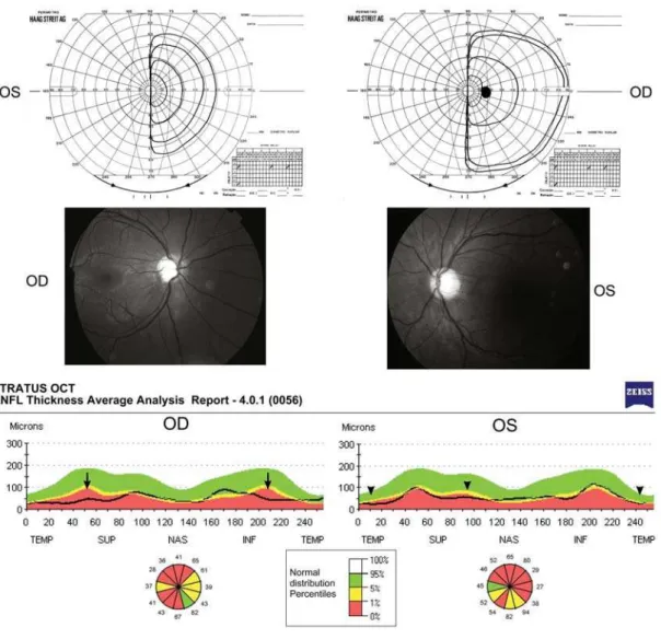 Figure 1: Case 1 - Goldmann visual fields showing complete left homonymous hemianopia