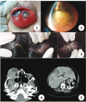 Figure 1: 1) Hard mass involving the entire orbital rim, with supe- supe-rior temporal hyperpigmentation ; 2) Intense neovascularization of the anterior segment, cataract and flat anterior chamber; 3) Hyperpigmented and elevated lesions in the scalp; 4) CT