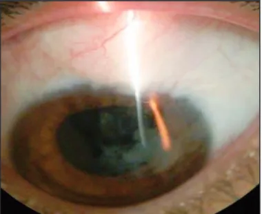 Figure 3:  Elevated and slightly anemic bleb 91 months after HB resection (patient 1); Note the healed conjunctiva over the periphery of the cornea