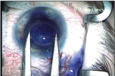 Figure 2:  The excised anterior capsule placed onto the corneal surface measured with an mm