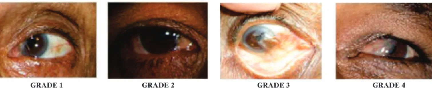 Figure 1: Pterygium grading severity (1-4); a) grade 1- at the conjunctiva (to the limbus); b) grade 2 - 1-2mm across the cornea;  c) grade 3 - to the pupil;   d) grade 4 - half way across the pupil