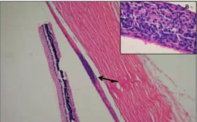 Figure 1: (A) Panoramic view of histological section of the eye treated with triamcinolone acetonide showing, from right to left: sclera, choroid with lymphoid aggregate (arrow) and retina; (B) detail of choroidal lymphoid aggregate with a predominance of 