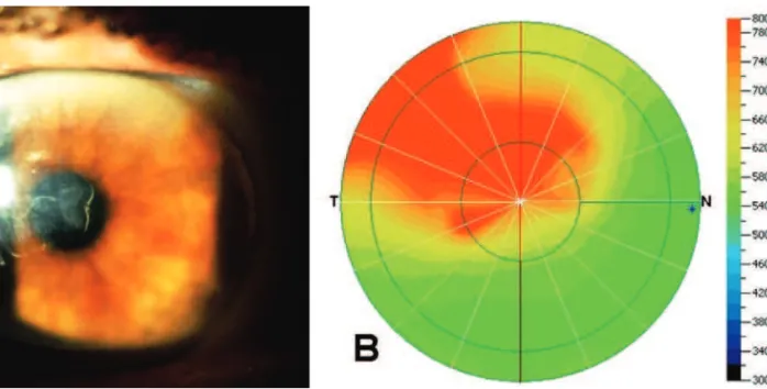 Figure 1: A) Localized corneal edema, extending from the side port incision to the central area; B) Pachymetric map of the cornea, showing the localized corneal thickening; C) Descemet’s membrane detachment adjacent to the superior temporal corneal side po