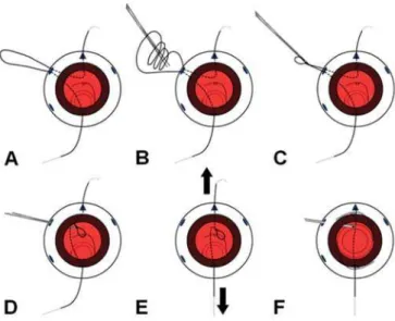 Figure 1 A, Capture and externalisation of the 10-0 prolene suture;