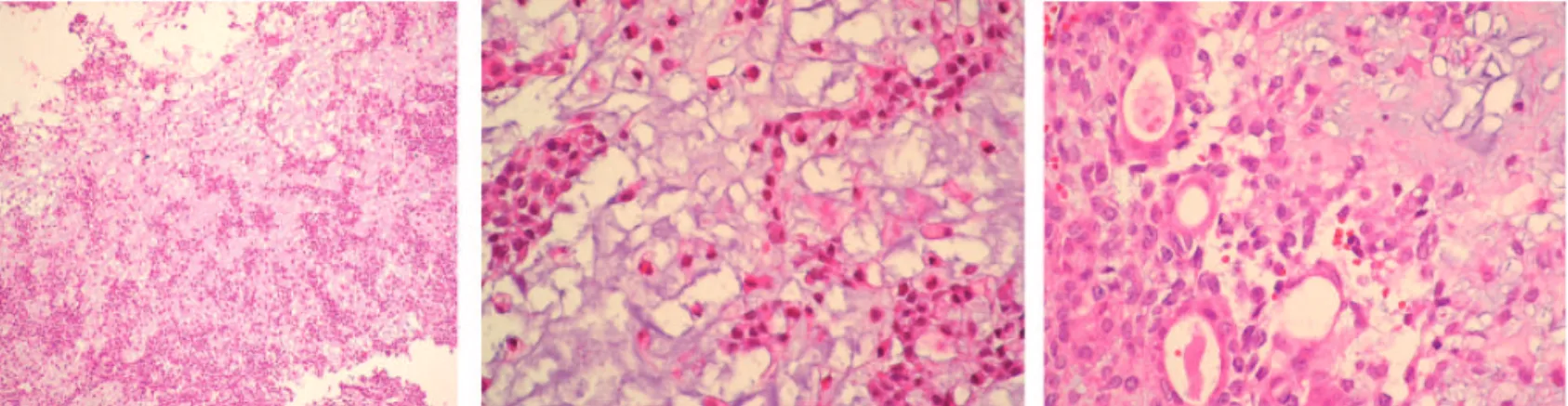 Figure 5: Areas with myxoid stroma and typical cellular components (ductal structures and myoepithelial cells)Iyeyasu JN, Reis F , AltemaniAM, Carvalho KM