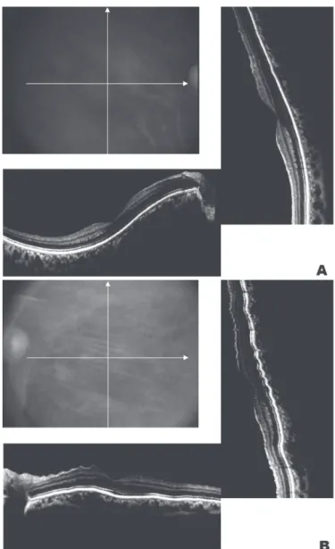 Figure 2: Optical coherence tomography of both eyes of the same patient. Perpendicular cuts through the centre of the fovea in an orientation similar to fundus examination