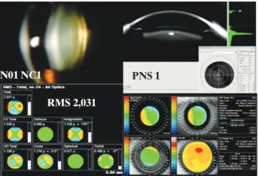 Figure 4: Schematic analysis of the subjective, objective and qualitative assessment of lens N01NC1 using the LOCS III classification