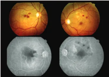 Figure 1:  Bilateral retinal and macular ischemia due to capillary filling defect