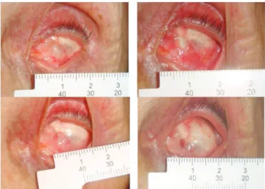 Figure 1: Appearance before (left) and after (right) the injection of 25% TCA