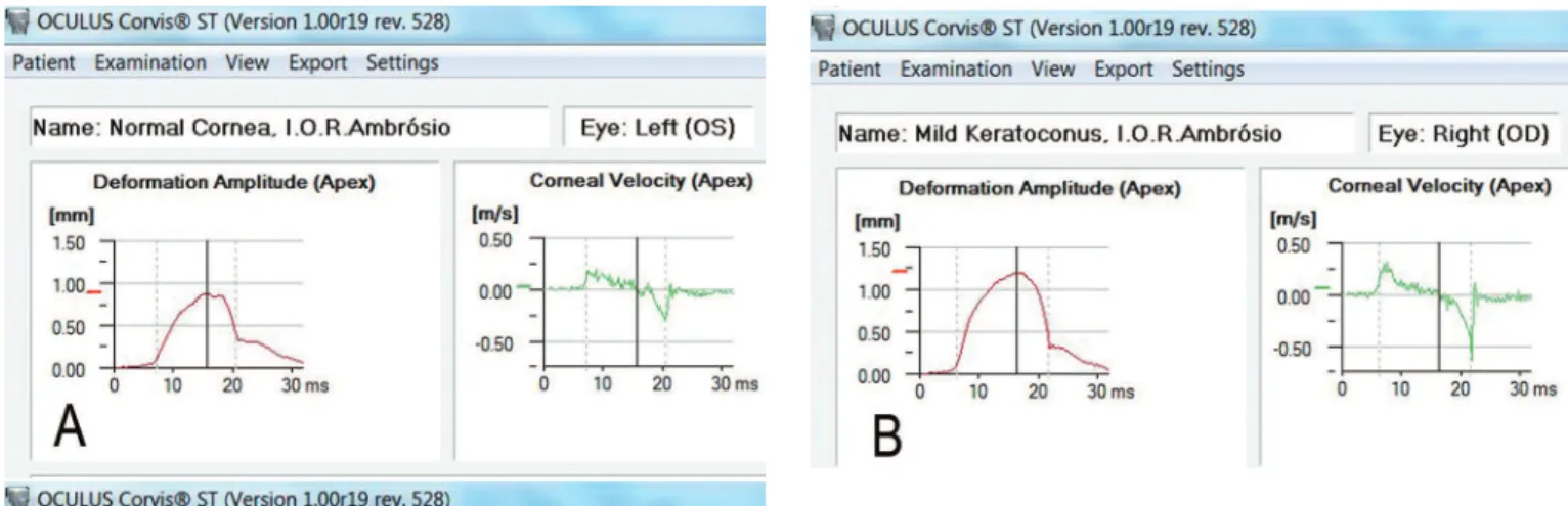 Figure 3: Selected Scheimpflug image frames of a normal cornea during the measurement