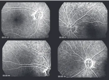 Figure 1: Leakage and venous staining suggesting periphlebitis Figure 2: Fluorescent angiography after treatmentAsymptomatic ocular sarcoidosis