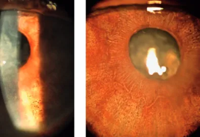 Figure 2: Biomicroscopy of the anterior segment during a follow-up visit. Note the intense iris depigmentation and keratic precipitates.