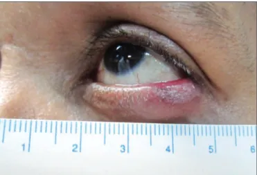 Figure 2: Right eye. (A) Before surgical treatment, the original lesion (arrow) consisted of an erythematous plaque with localised loss of eyelashes in the middle and lateral thirds of the upper eyelid