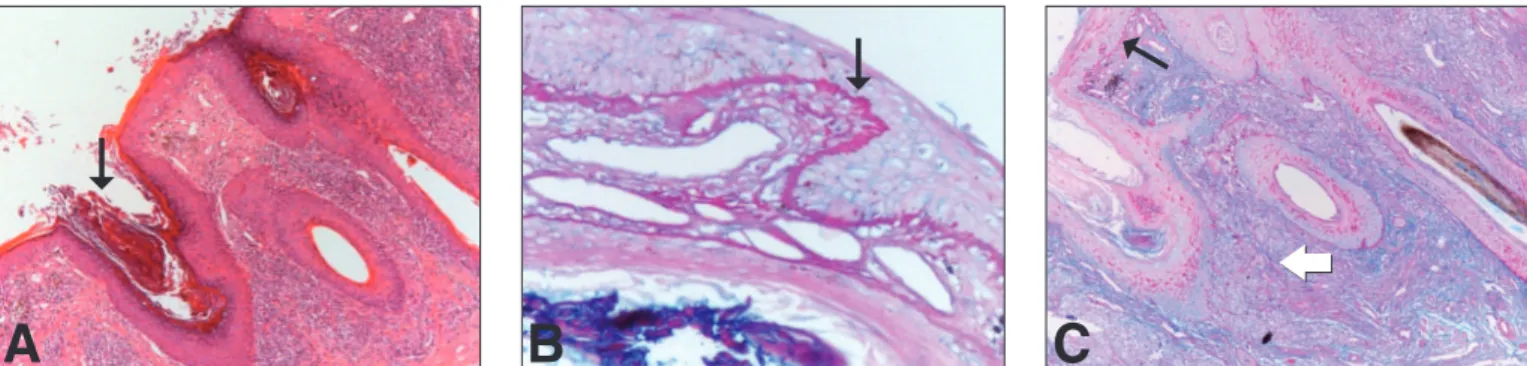 Figure 3: A sample of eyelid skin. (A) The epidermis shows parakeratosis with follicular plugs (arrow) and atrophy
