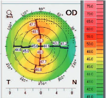 Figure 2 shows normal anterior and posterior elevation maps and subtraction maps moving towards the green area (<12 ìM), which represents comfort and safety