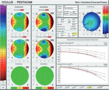 Figure 2. B/A Enhanced ectasia of the right eye Figure 3. B/A Enhanced ectasia of the left eye