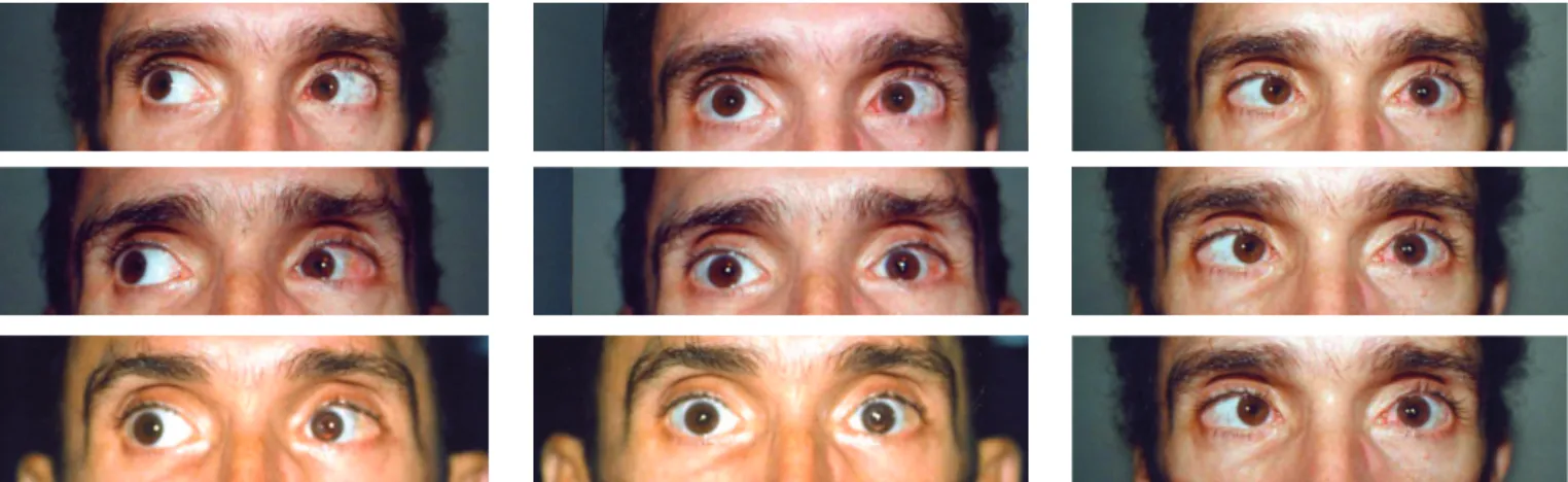 Figure 17 - Patient with traumatic right VI nerve palsy. The accident also caused a penetrating injury of the cornea and lens of the left eye, with loss of vision due to secondary glaucoma and intense corneal leukoma