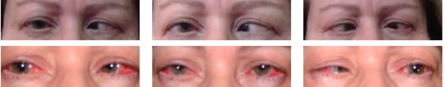 Figure 20 - Patient with traumatic bilateral VI nerve paralysis, fixation with the right eye, deviation angle over 100 prism diopters; moderate contracture of the right medial rectus and severe contracture of the left medial rectus