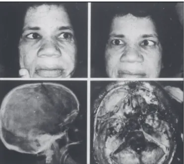 Figure 3 – A patient with high myopia and large esotropia, without eye movement either for abduction, elevation or depression in both eyes