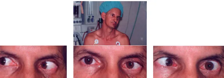 Figure 13 - Patient with traumatic left VI nerve palsy and significant limitation of abduction, not reaching the midline