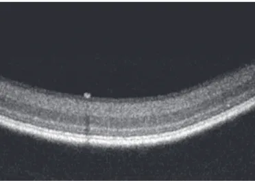 Figure 7: OCT of stimulated retina with BT; no SD is seen