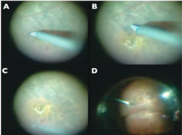 Figure 4: RPE changes after ILM peeling in macular hole surgery guided by 5mg/mL of indocyanine green; A - Fundus photography showing that macular hole is sealed