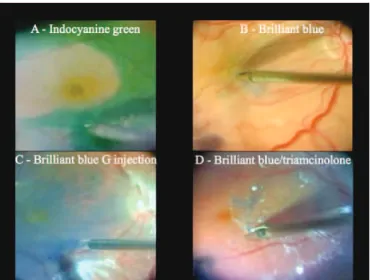 Figure 7: Summary of the ILM peeling techniques during the chromovitrectomy: A - ILM peeling guided by ICG staining 0.5mg/