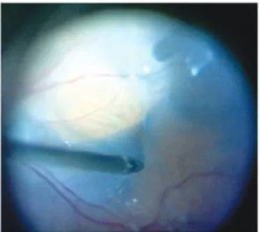 Figure 8: A combination of 0.3mL of TB 1.5mL/mL and 0.1mL f glucose 5% solution injected in a fluid-filled technique;  this dye solution is denser than water that might avoid contact at the posterior capsule of the lens and is helpful to maintain selective