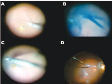 Figure 11: Triancinolone acetonide - guided posterior hyaloid dissection; note that TA crystals deposits to the acellular vitreous gel, providing a clear visualization of the posterior vitreous cortex