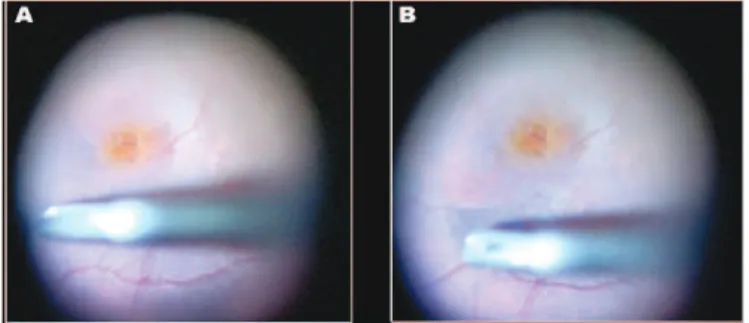 Figure 14: Dye deposition at the ILM in an eye with a macular hole;